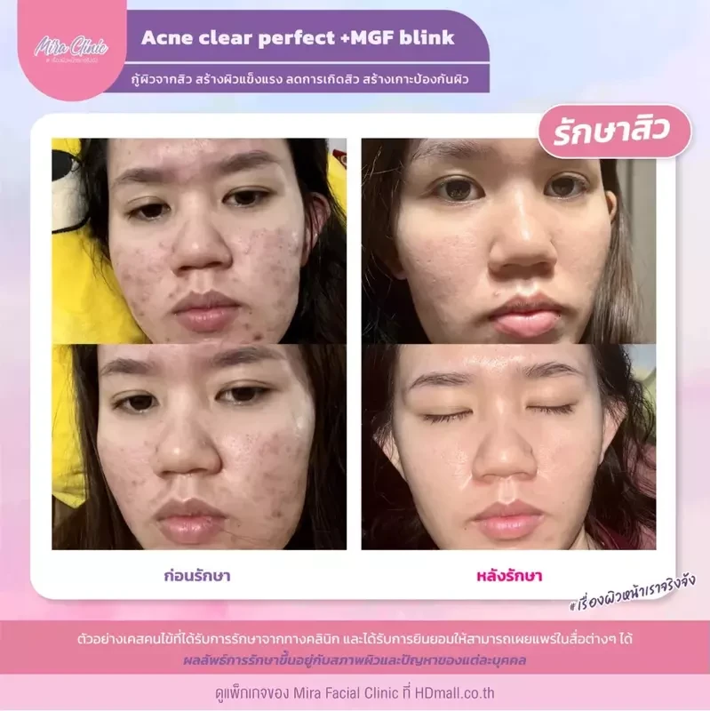 รีวิว รักษาสิว ที่ Mira Facial Clinic