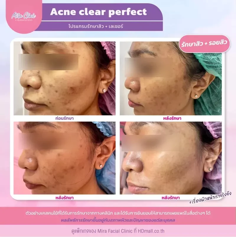 รีวิว รักษาสิว ที่ Mira Facial Clinic