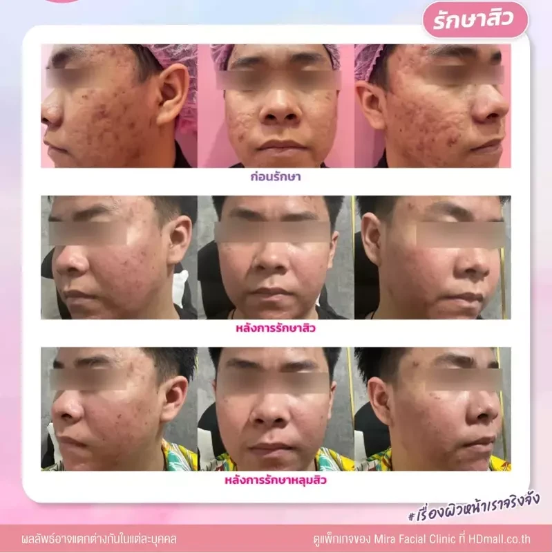 รีวิว รักษาสิว ที่ Mira Facial Clinic