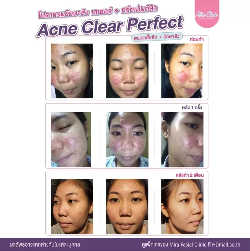 รีวิว รักษาสิว ที่ Mira Facial Clinic