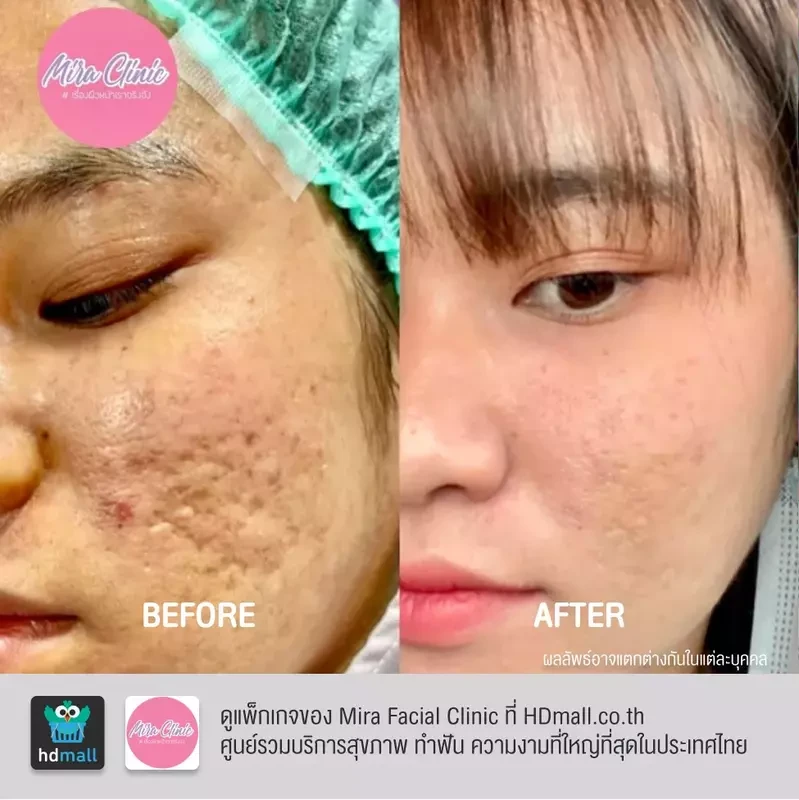 รีวิว รักษาสิว ที่ Mira Facial Clinic