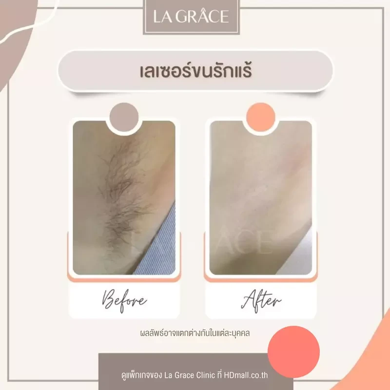 รีวิว กำจัดขนรักแร้ ที่ La Grace Clinic