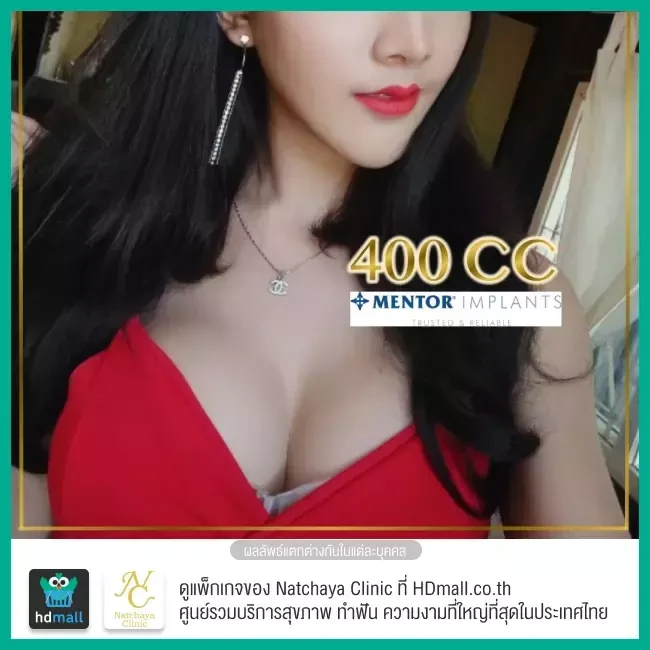 Before After รีวิวเสริมหน้าอก ที่ Natchaya Clinic (ณัฐชญาคลินิก)