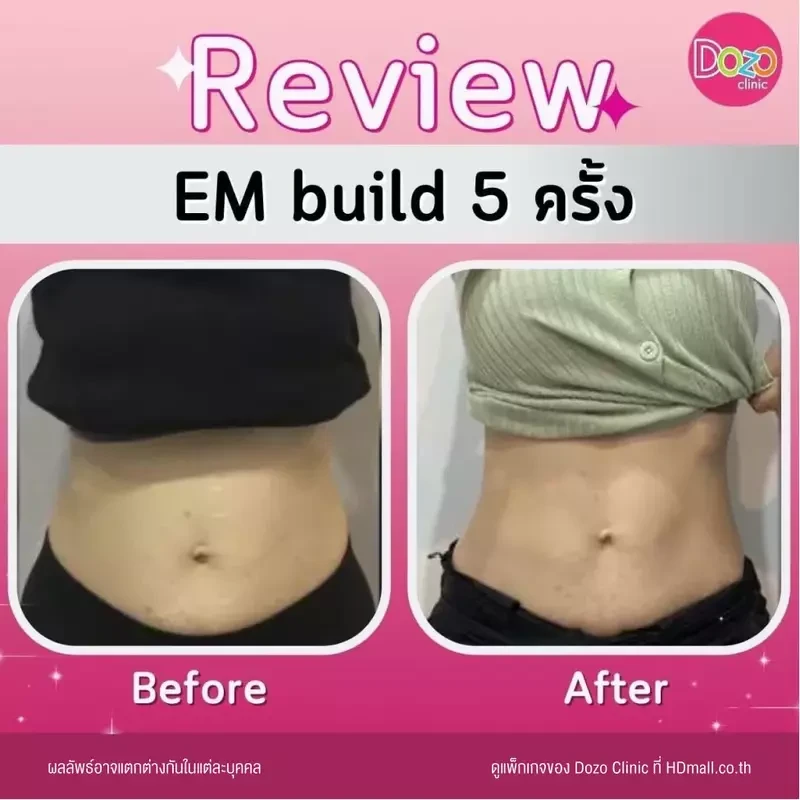 รีวิว สร้างกล้ามเนื้อ สลายไขมัน ด้วย EM Build ที่ Dozo Clinic