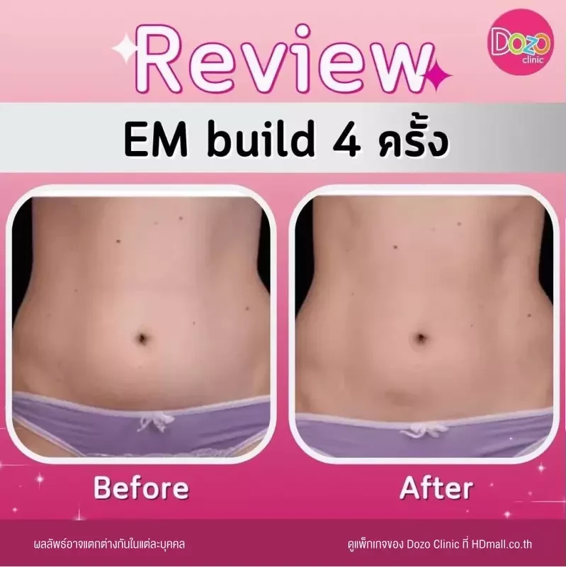 รีวิว สร้างกล้ามเนื้อ สลายไขมัน ด้วย EM Build ที่ Dozo Clinic