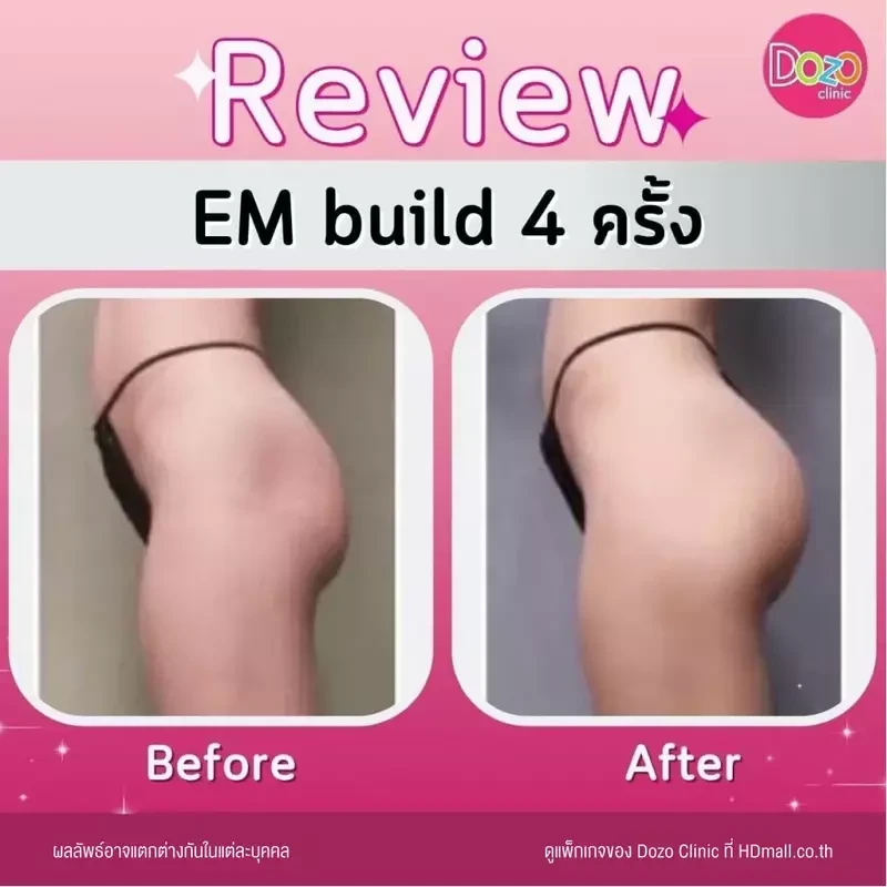 รีวิว สร้างกล้ามเนื้อ สลายไขมัน ด้วย EM Build ที่ Dozo Clinic