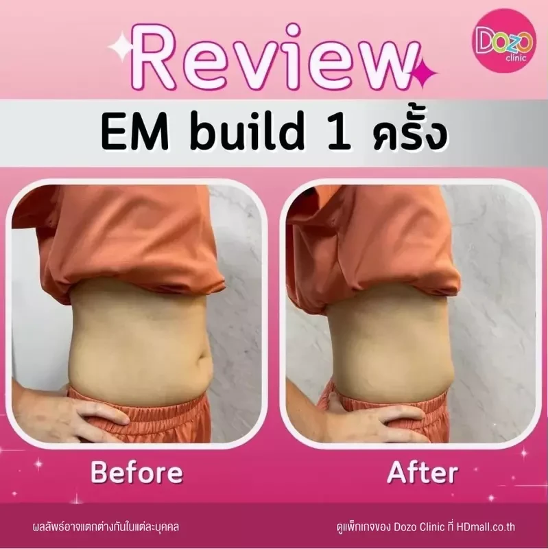 รีวิว สร้างกล้ามเนื้อ สลายไขมัน ด้วย EM Build ที่ Dozo Clinic