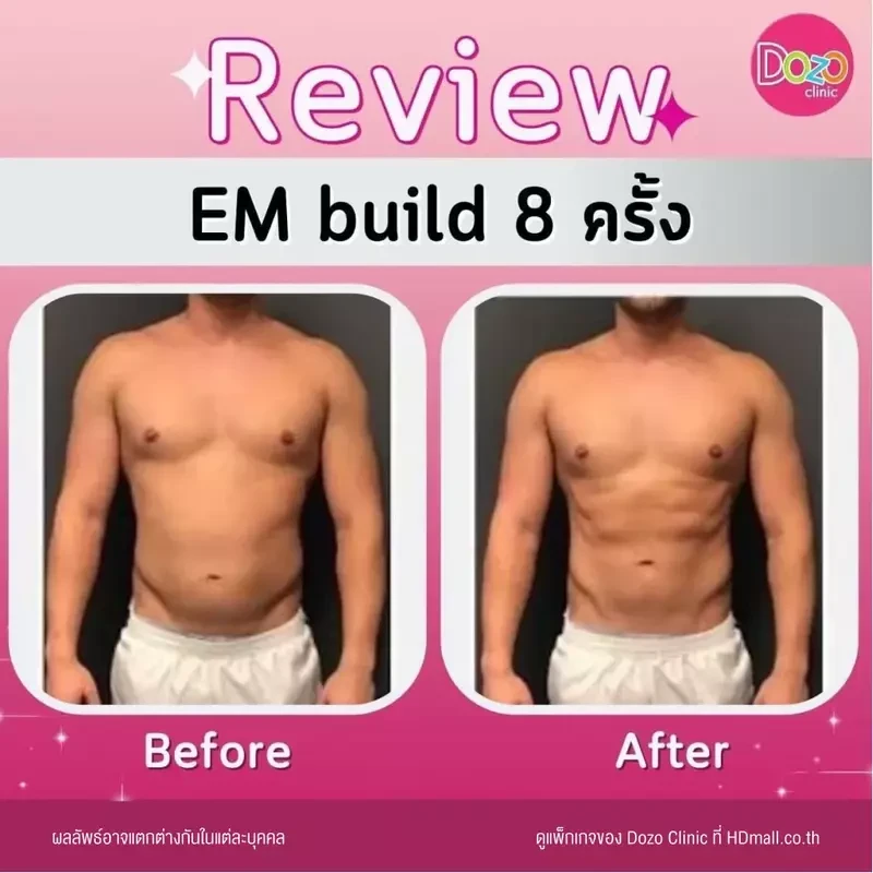 รีวิว สร้างกล้ามเนื้อ สลายไขมัน ด้วย EM Build ที่ Dozo Clinic