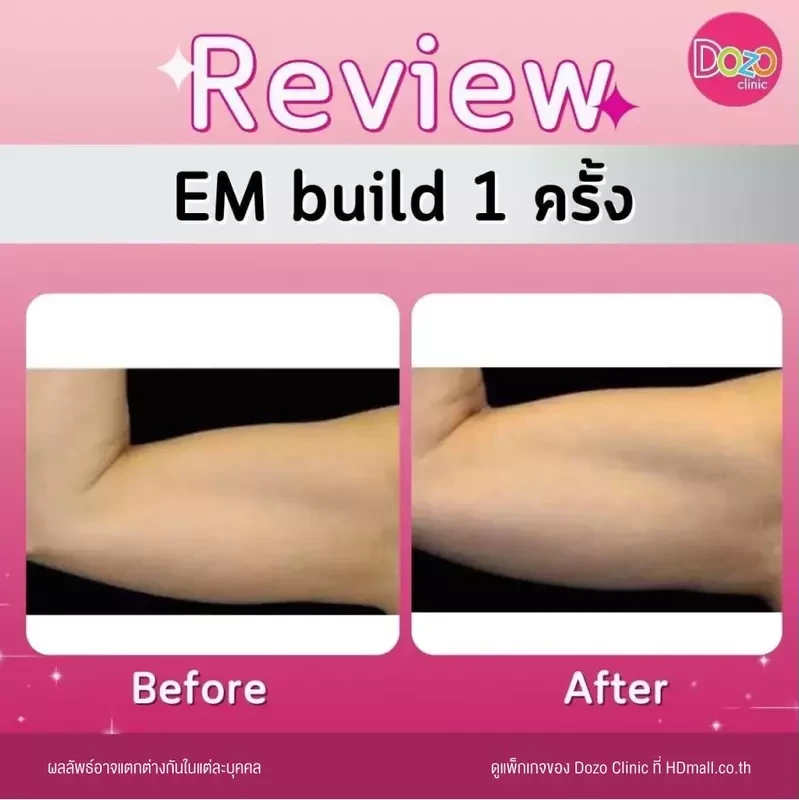 รีวิว สร้างกล้ามเนื้อ สลายไขมัน ด้วย EM Build ที่ Dozo Clinic