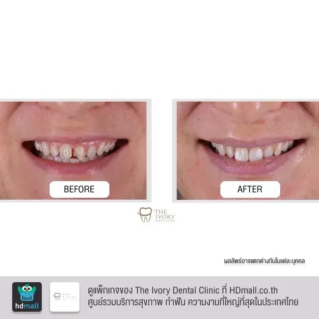 รีวิว ทำวีเนียร์ เซรามิก ที่ The Ivory Dental Clinic
