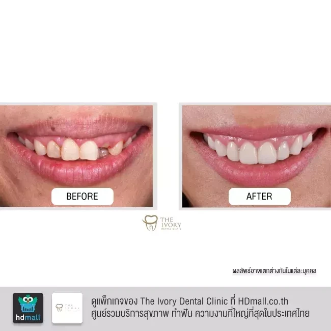 รีวิว ทำวีเนียร์ เซรามิก ที่ The Ivory Dental Clinic