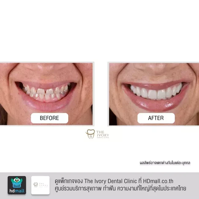 รีวิว ทำวีเนียร์ เซรามิก ที่ The Ivory Dental Clinic