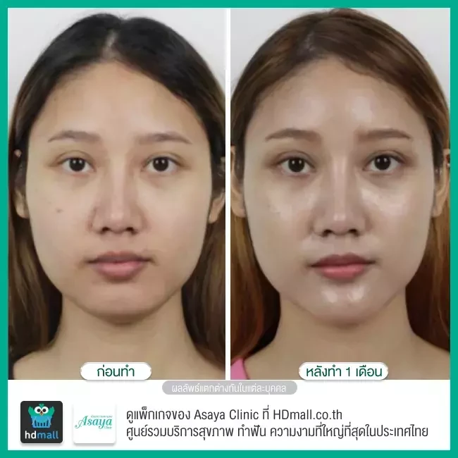 Before After ทำคาง ศัลยกรรมเสริมคาง ที่ Asaya Clinic (อาศยาคลินิก)