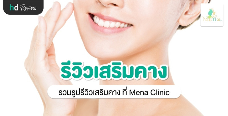 รีวิว เสริมคาง ที่ Mena Clinic 10 รีวิว เสริมคาง ที่ Mena Clinic