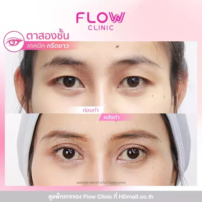 รีวิว ทำตาสองชั้นแบบกรีดยาว ที่ Flow Clinic