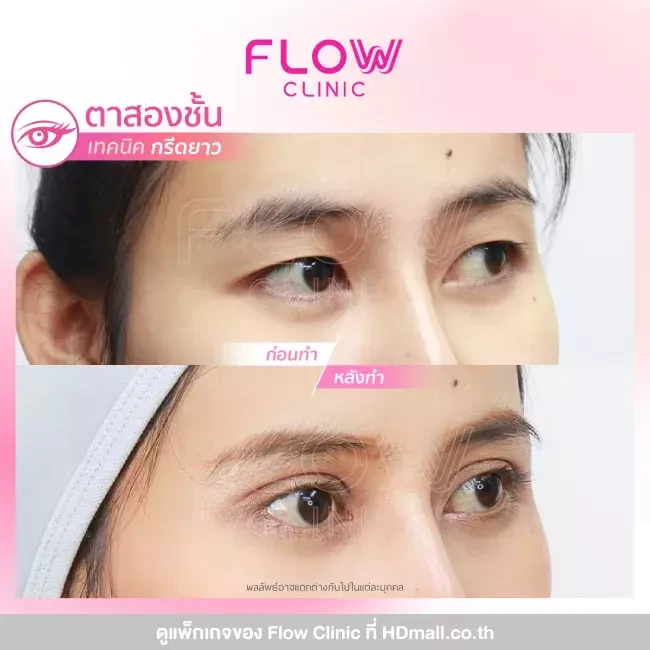รีวิว ทำตาสองชั้นแบบกรีดยาว ที่ Flow Clinic
