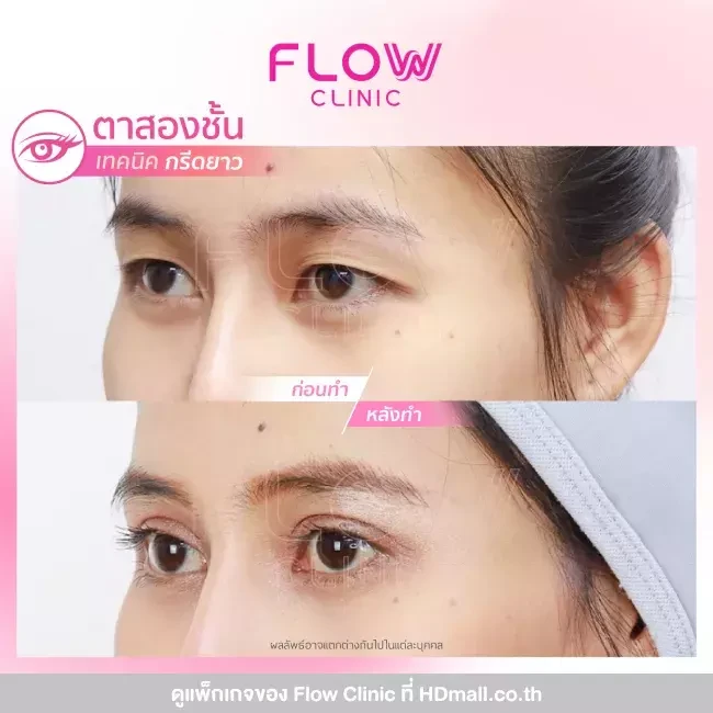รีวิว ทำตาสองชั้นแบบกรีดยาว ที่ Flow Clinic