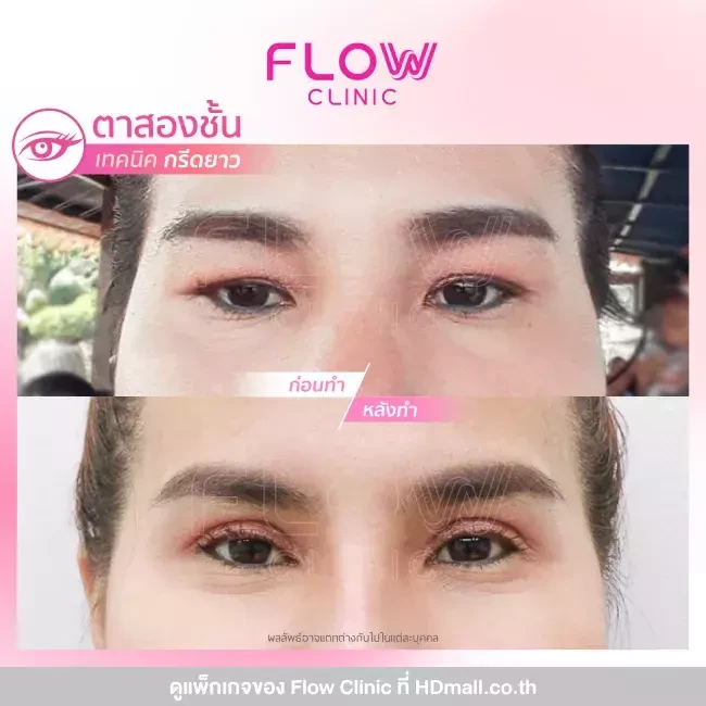 รีวิว ทำตาสองชั้นแบบกรีดยาว ที่ Flow Clinic