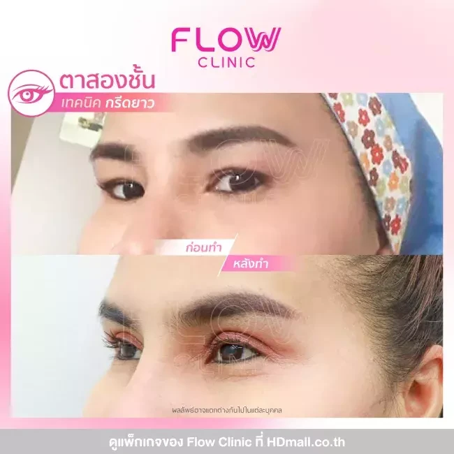 รีวิว ทำตาสองชั้นแบบกรีดยาว ที่ Flow Clinic