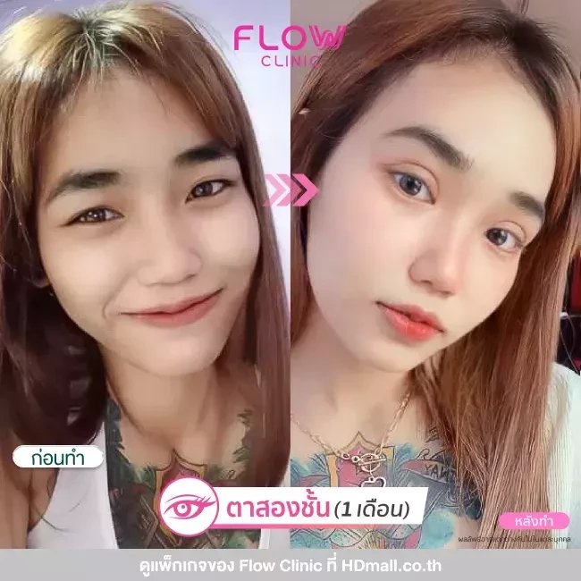 รีวิว ทำตาสองชั้นแบบกรีดยาว ที่ Flow Clinic
