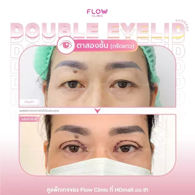 รีวิว ทำตาสองชั้นแบบกรีดยาว ที่ Flow Clinic