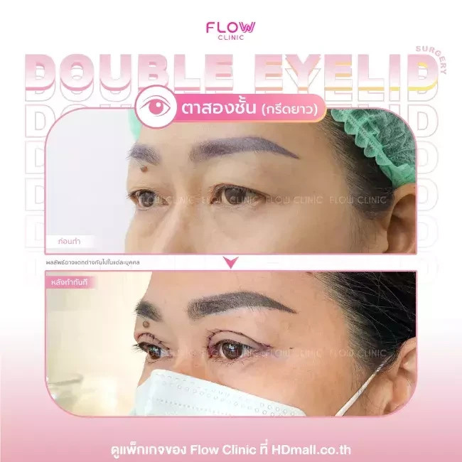 รีวิว ทำตาสองชั้นแบบกรีดยาว ที่ Flow Clinic