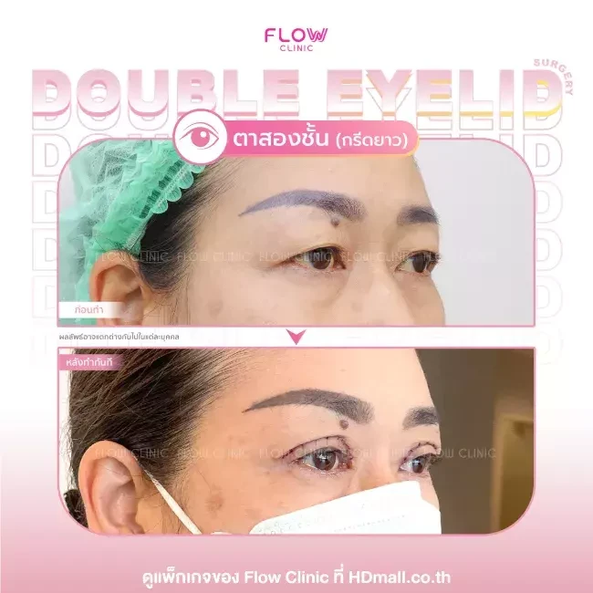 รีวิว ทำตาสองชั้นแบบกรีดยาว ที่ Flow Clinic