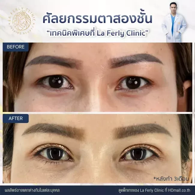 รีวิว ทำตาสองชั้น ที่ La Ferly Clinic