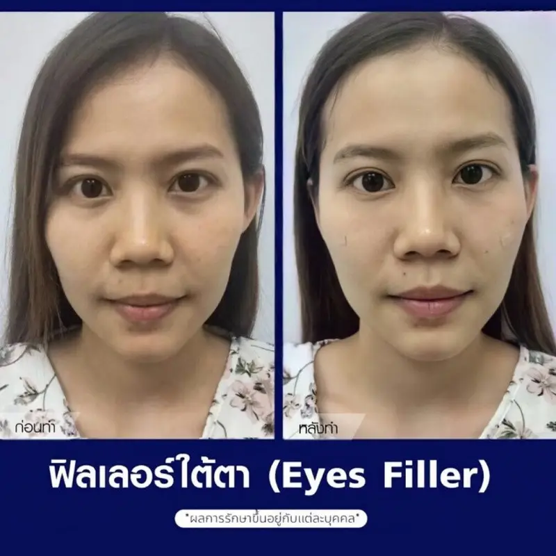 รีวิวฉีดฟิลเลอร์ ใต้ตา ที่ The East Clinic