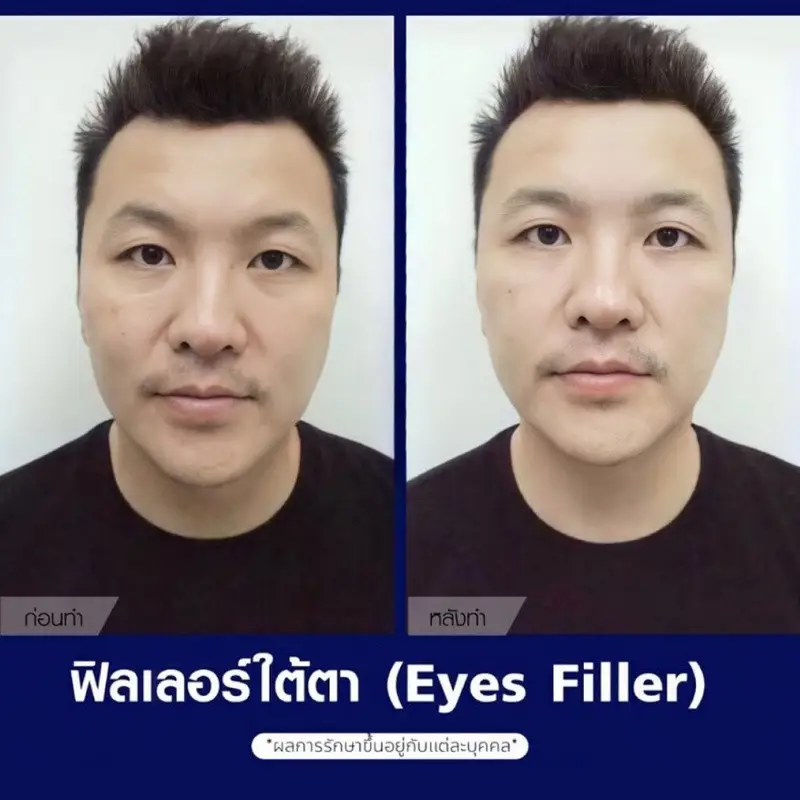 รีวิวฉีดฟิลเลอร์ ใต้ตา ที่ The East Clinic