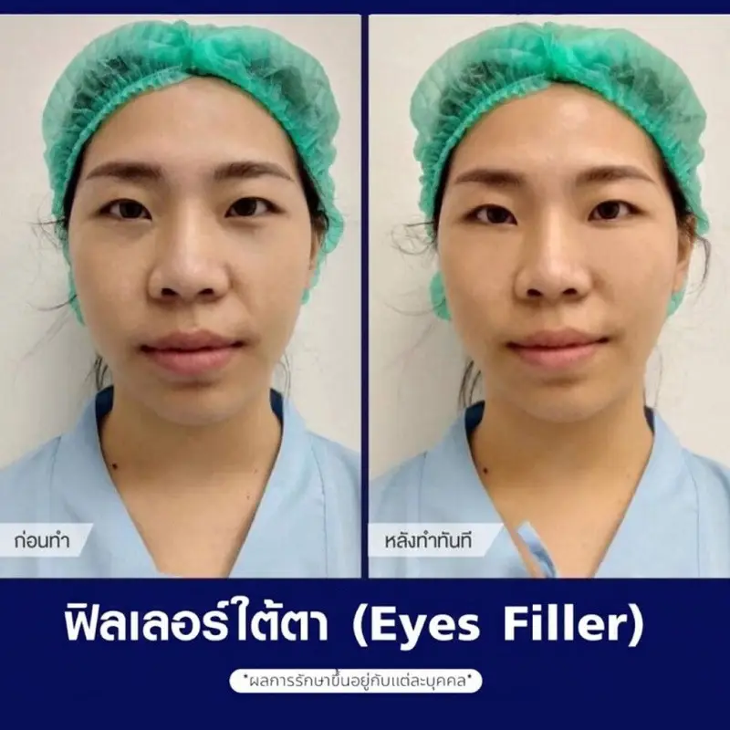 รีวิวฉีดฟิลเลอร์ ใต้ตา ที่ The East Clinic