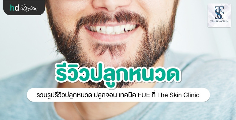 รีวิว ปลูกหนวด ปลูกจอน เทคนิค FUE ที่ The Skin Clinic 11 รีวิว ปลูกหนวด ปลูกจอน