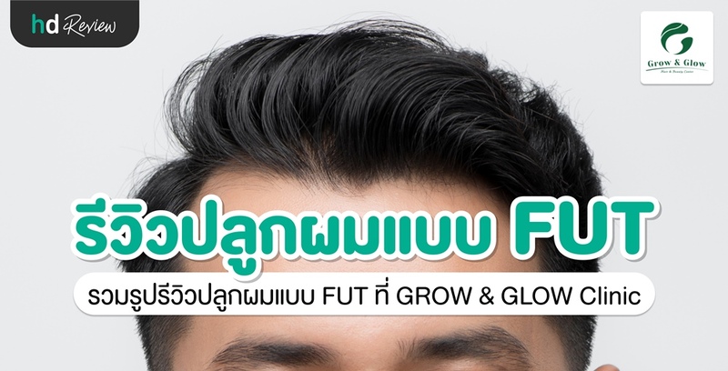 รีวิวปลูกผมแบบ FUT ที่ GROW & GLOW Clinic