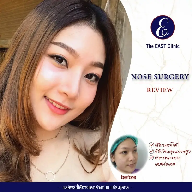 รีวิว เสริมจมูก ที่ The East Clinic