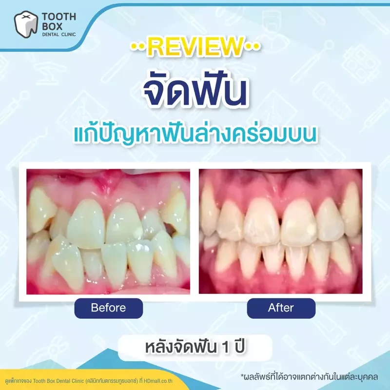 รีวิว จัดฟัน ที่ Tooth Box Dental Clinic (คลินิกทันตกรรมทูธบอกซ์)