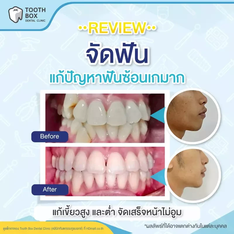 รีวิว จัดฟัน ที่ Tooth Box Dental Clinic (คลินิกทันตกรรมทูธบอกซ์)