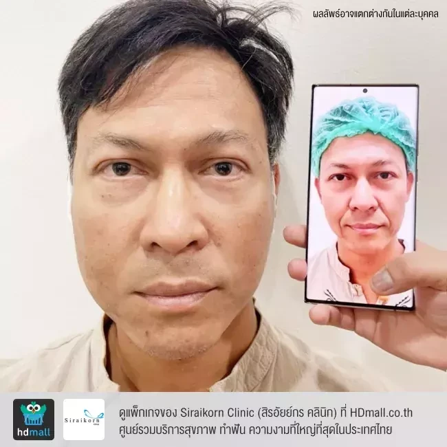 รีวิว ดึงหน้า ที่ Siraikorn Clinic (สิรอัยย์กร คลินิก)