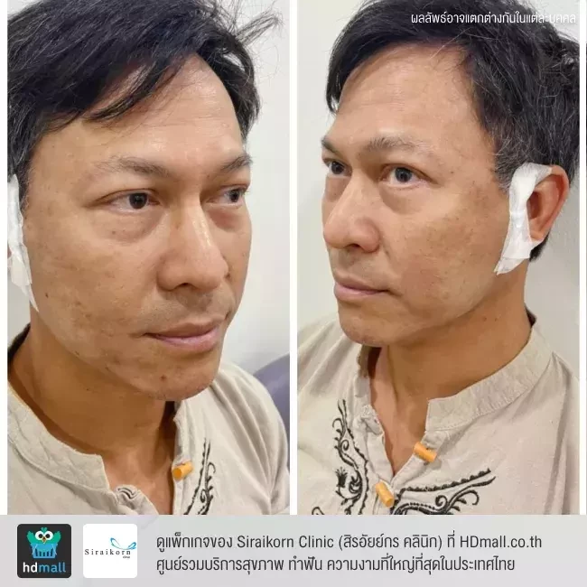 รีวิว ดึงหน้า ที่ Siraikorn Clinic (สิรอัยย์กร คลินิก)