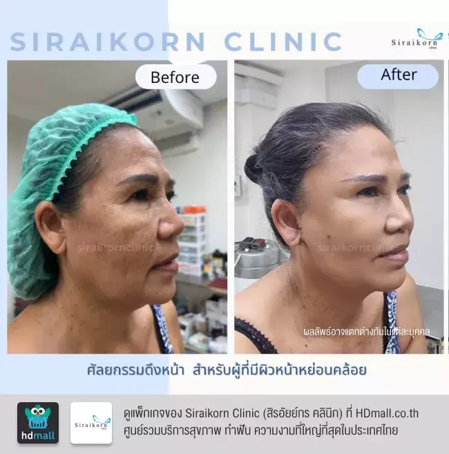 รีวิว ดึงหน้า ที่ Siraikorn Clinic (สิรอัยย์กร คลินิก)