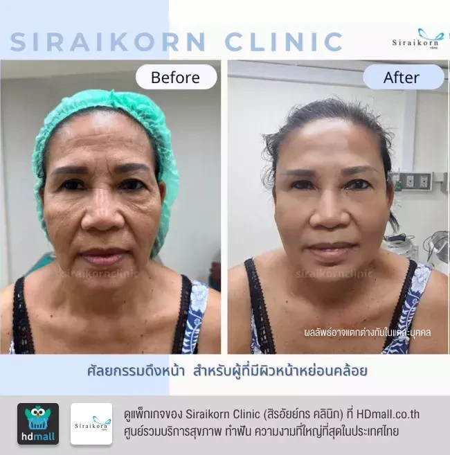รีวิว ดึงหน้า ที่ Siraikorn Clinic (สิรอัยย์กร คลินิก)