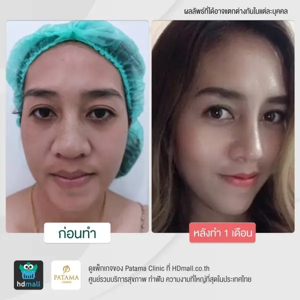 รีวิว เสริมจมูก ทรงสโลป ปลายพุ่ง ที่ Patama Clinic