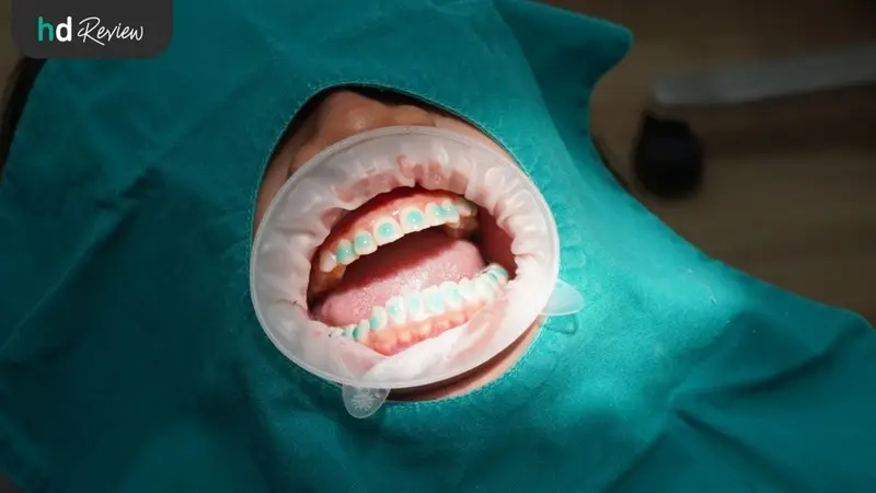 รีวิว จัดฟันแบบเซรามิก ที่ Grace Dental Clinic