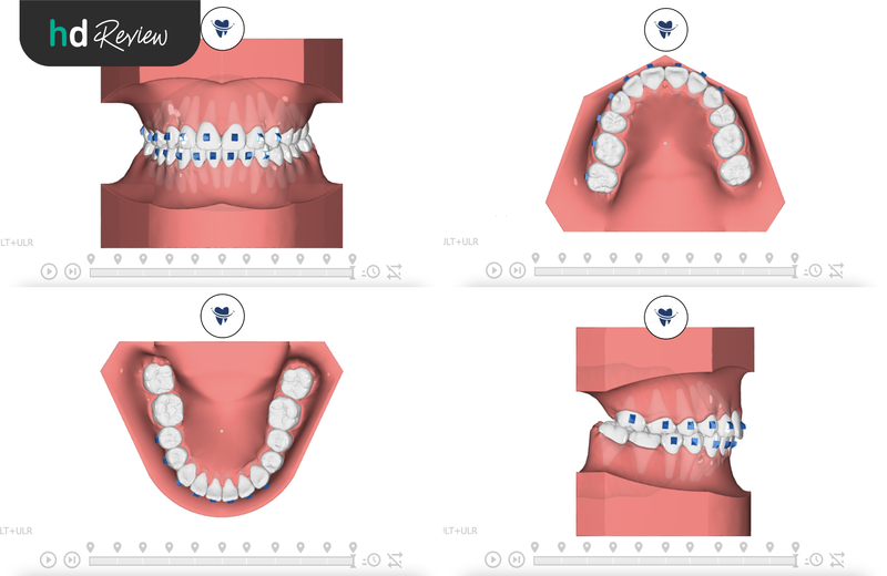 ขั้นตอนทำ 3D Scan ก่อนจัดฟันใส