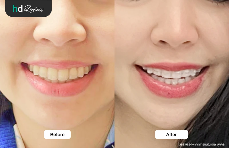 ผลลัพธ์หลังจัดฟันใสกับ Dr Clear Aligners