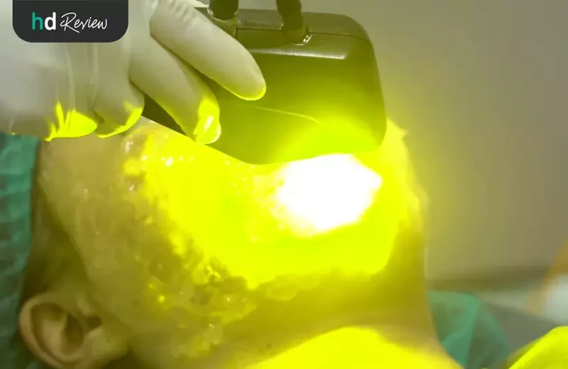 ทำ Dual Yellow Laser ที่ MN Clinic