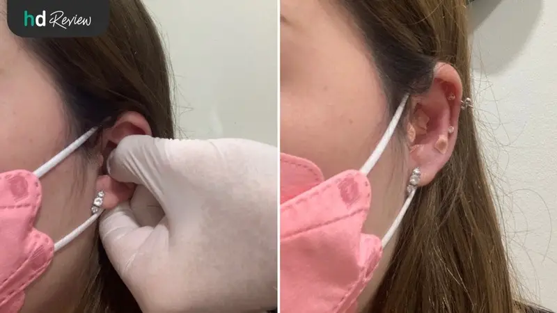 รีวิว ติดหมุดใบหู ลดความอยากอาหาร ที่ The Neighbourhood TCM Clinic