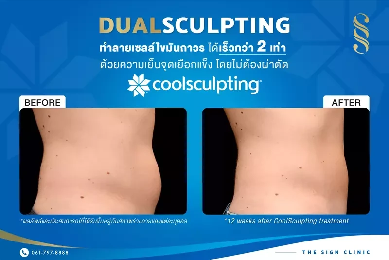 รีวิวผลลัพธ์การสลายไขมันด้วย CoolSculpting ที่ The Sign Clinic (ทองหล่อ)