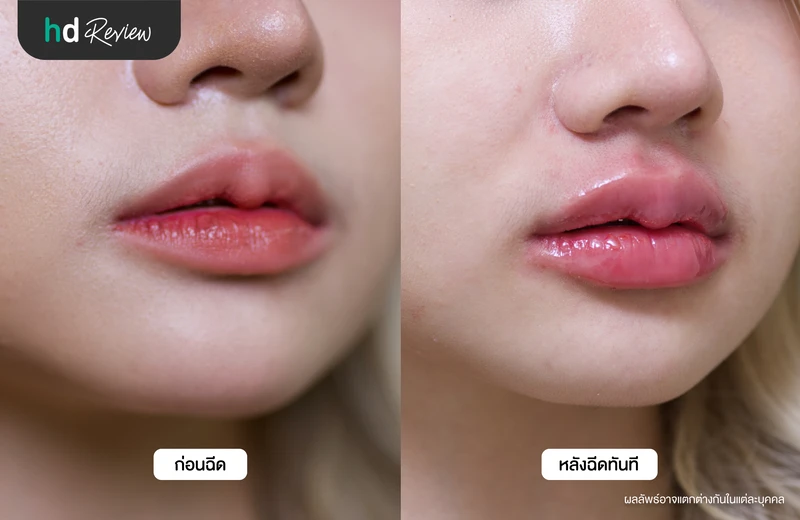 ภาพเปรียบเทียบก่อนและหลังฉีดฟิลเลอร์ปากมุมข้าง