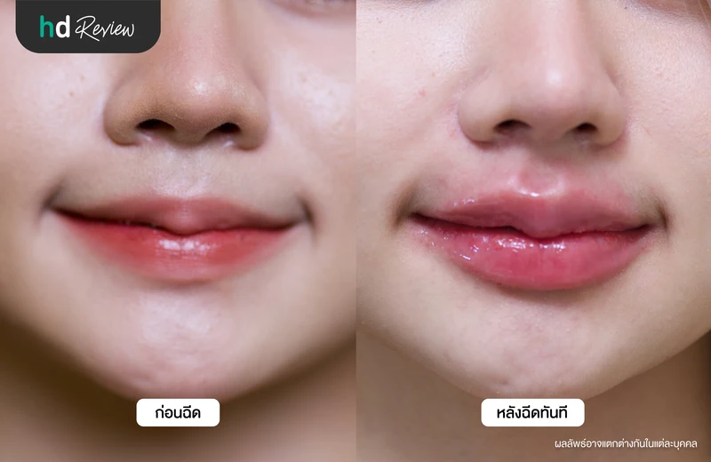 ภาพเปรียบเทียบก่อนและหลังฉีดฟิลเลอร์ปาก
