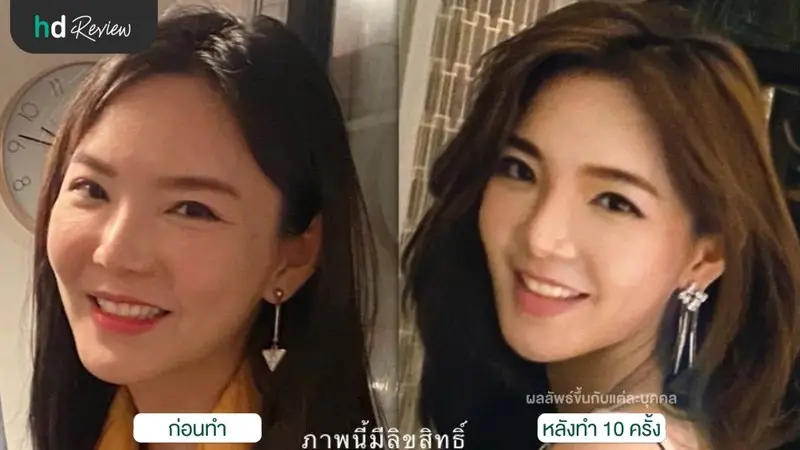 รีวิว นวดกัวซายกกระชับใบหน้า ที่ Veora Spa นวดหน้า สปาผิว